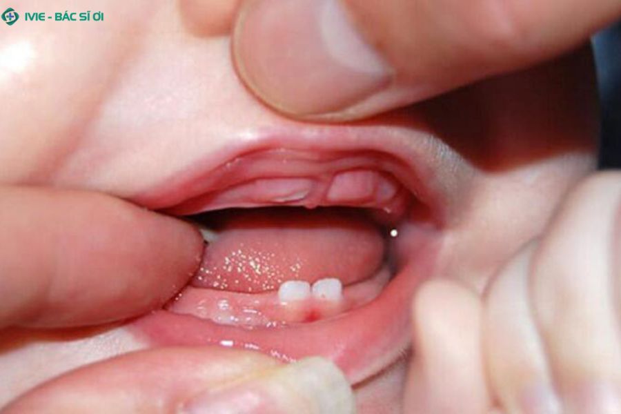 Cách chăm sóc bé 7 tháng mọc răng tại nhà