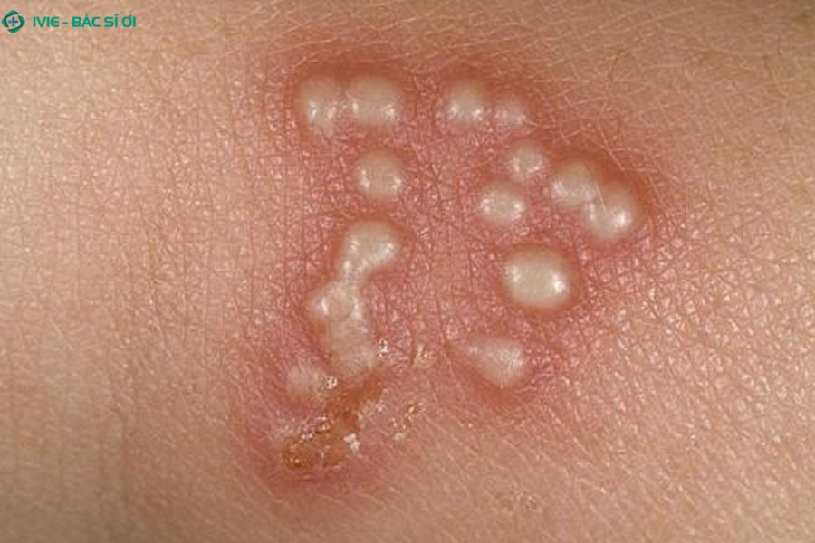 Nhận diện sớm các dấu hiệu bất thường như mụn lạ hay cảm giác đau rát là bước đầu tiên để bảo vệ sức khỏe bản thân