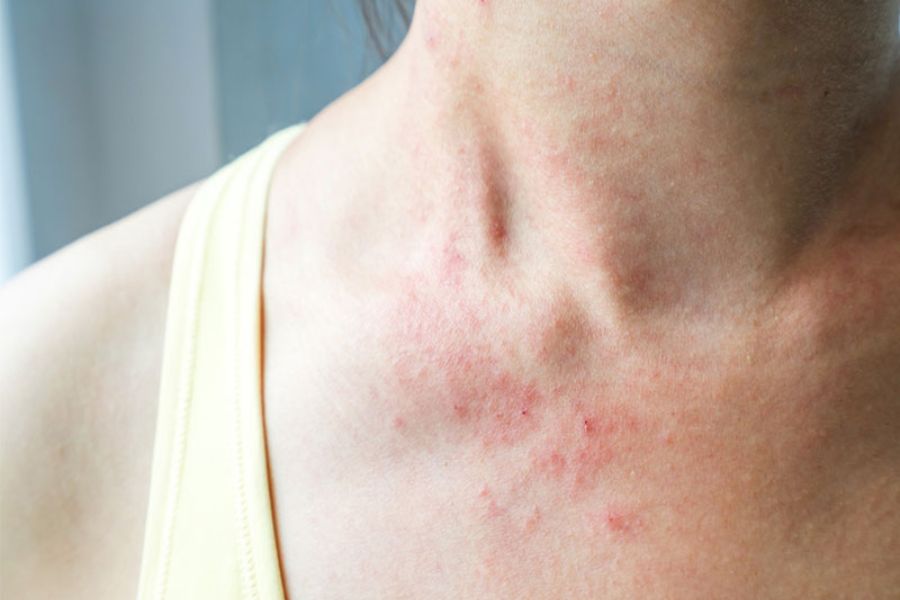 Hình ảnh minh họa vùng cổ bị viêm da cơ địa da khô ráp, đỏ và bong tróc