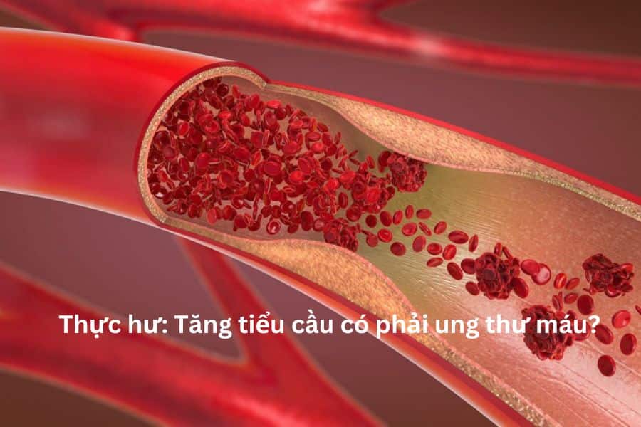 Thực hư: Tăng tiểu cầu có phải là ung thư máu?