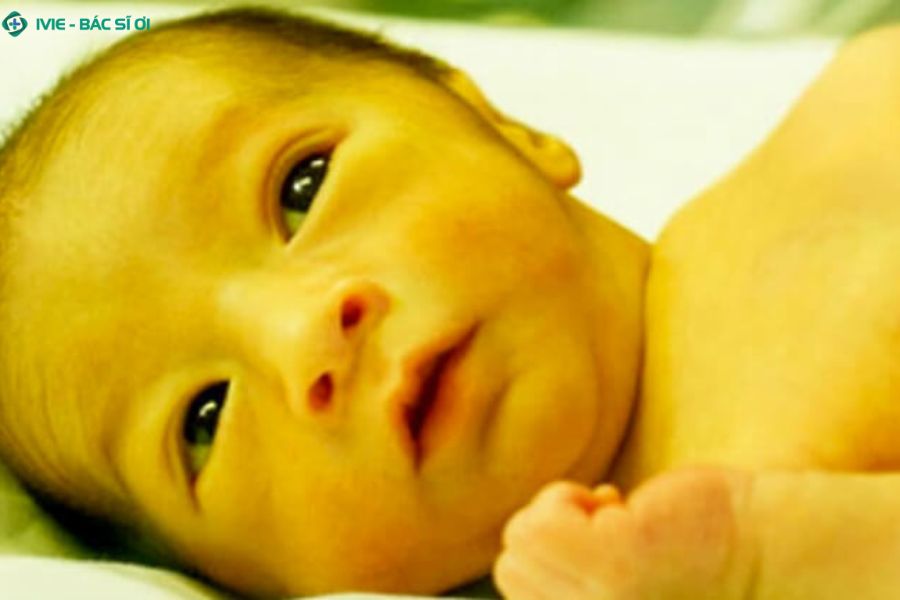Các dấu hiệu của trẻ 2 tháng tuổi vẫn vàng da