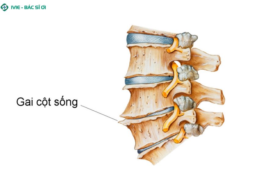 Vị trí thường gặp của gai cột sống ở cổ và thắt lưng