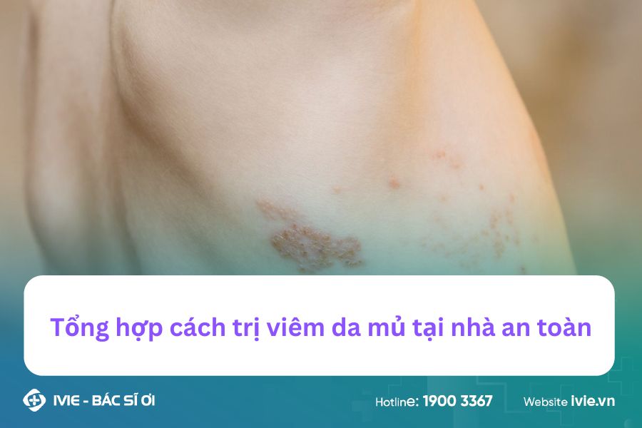 Tổng hợp cách trị viêm da mủ tại nhà an toàn