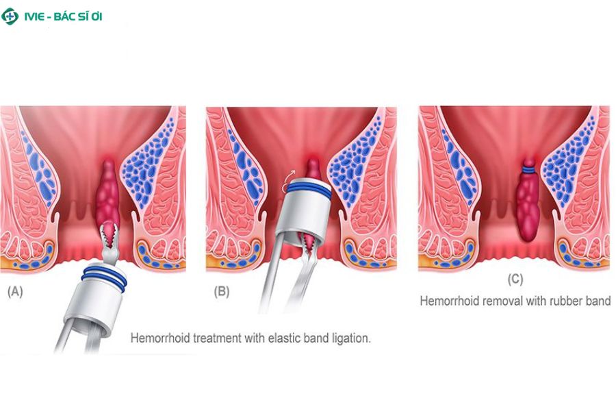 Thắt búi trĩ bằng vòng cao su giúp chặn máu nuôi búi trĩ, làm búi trĩ teo dần và co lại