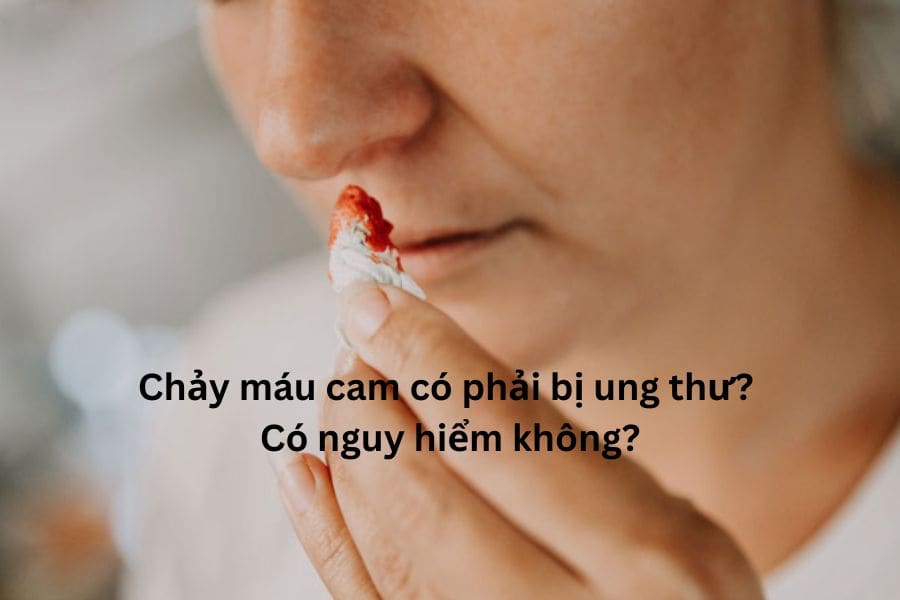 Chảy máu cam có phải bị ung thư? Có nguy hiểm không?