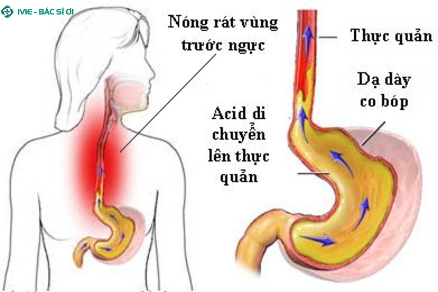 Bị trào ngược dạ dày cần lưu ý điều gì?