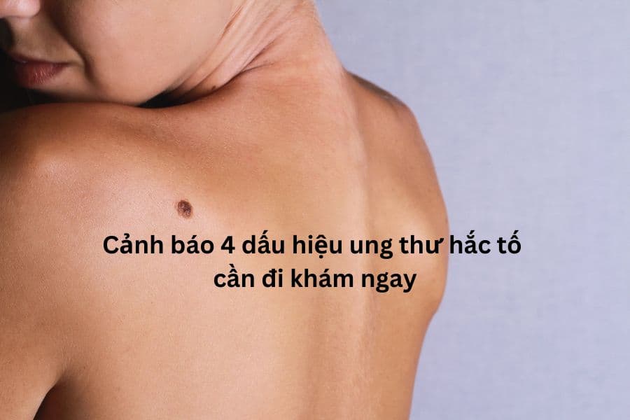Cảnh báo 4 dấu hiệu ung thư hắc tố cần đi khám ngay