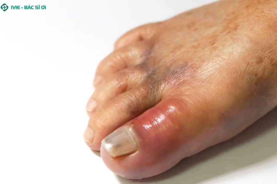 Cơn gout cấp gây sưng đau dữ dội ở ngón chân cái