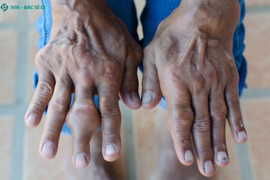 U bã đậu ở ngón tay có ahiểm không?