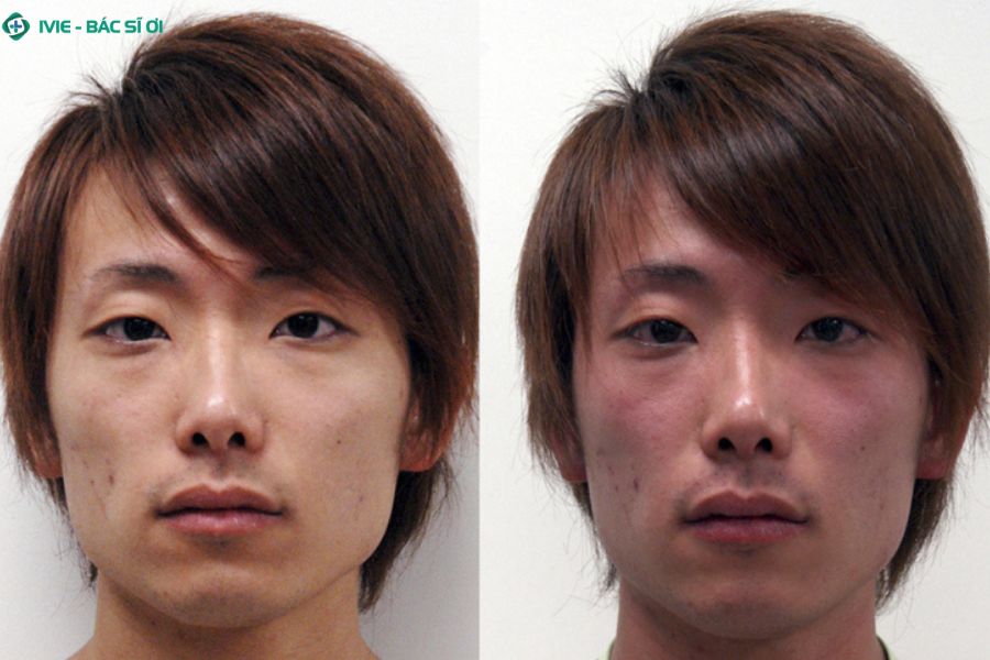 Cơ chế rối loạn chuyển hóa rượu dẫn đến hiện tượng đỏ mặt khi uống bia