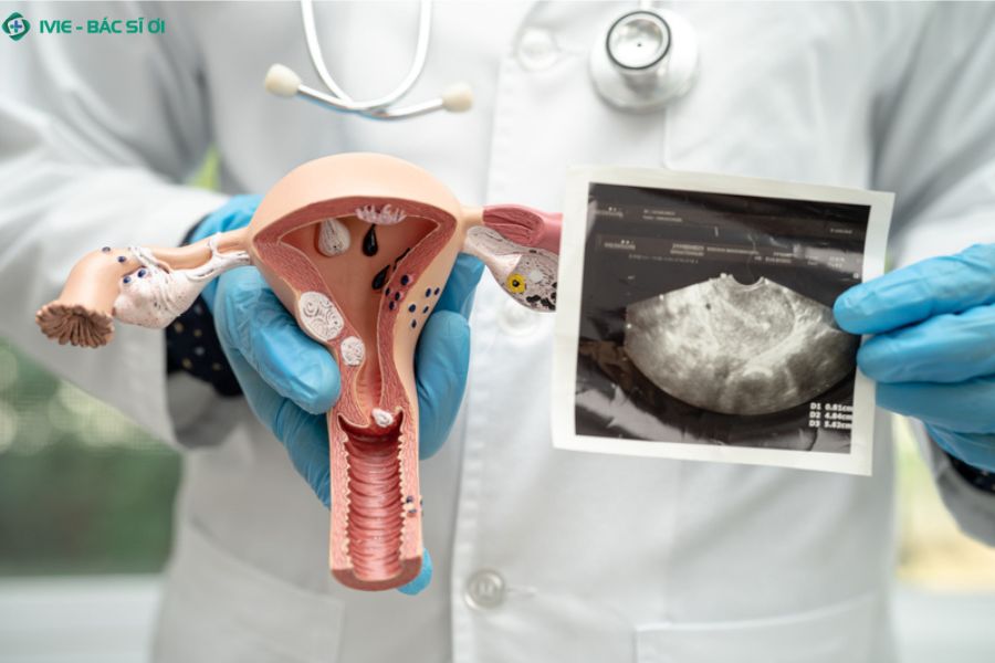 Các khối u xơ tử cung lớn nếu không được theo dõi và điều trị kịp thời có thể dẫn đến nhiều biến chứng sức khỏe nghiêm trọng