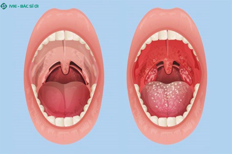 Không phải tất cả người bị viêm amidan mạn tính đều bị ung thư