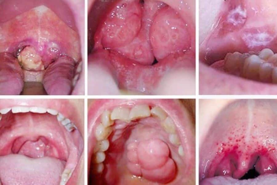 Giai đoạn cuối của bệnh sẽ có nguy cơ di căn