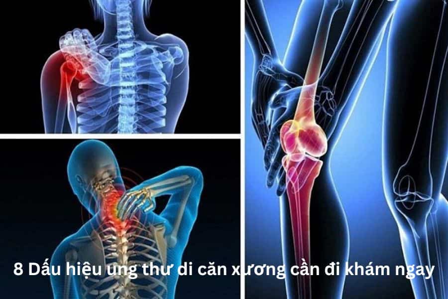 8 Dấu hiệu ung thư di căn xương cần đi khám ngay