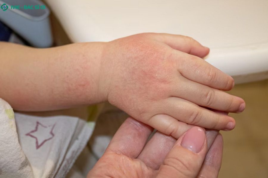 Cha mẹ không nên chủ quan khi trẻ nổi mẩn đỏ sau khi tiêm phòng