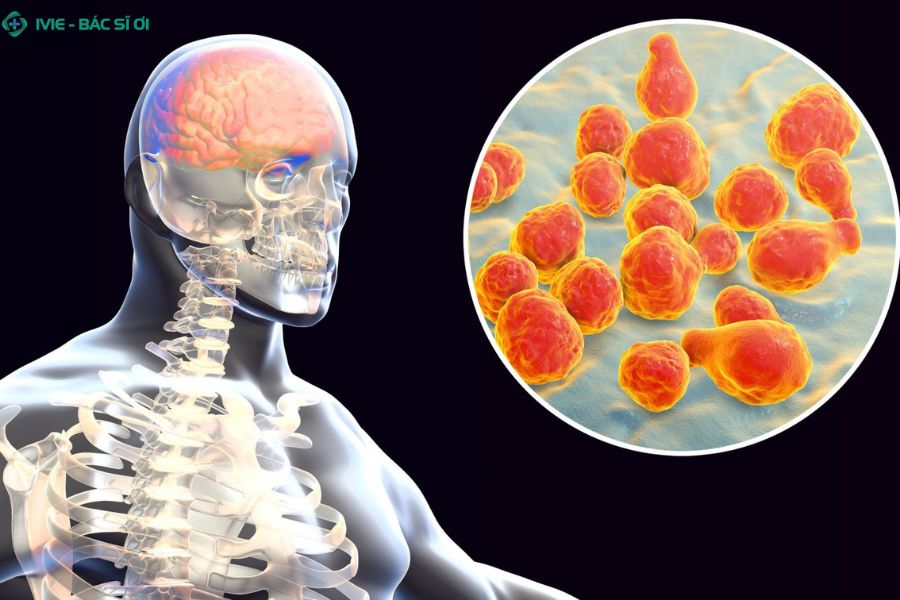 Viêm màng não mô cầu là bệnh gì