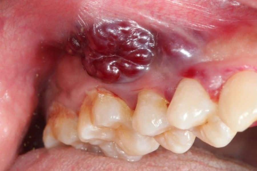 Bị ung thư niêm mạc má sẽ xuất hiện vết loét bên trong miệng