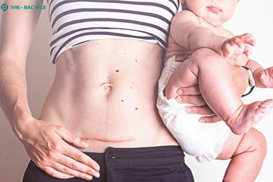 Đẻ mổ 2 lần có làm IVF được không
