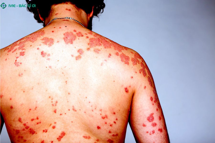 Các triệu chứng HIV giai đoạn đầu thường rất giống cảm cúm, đòi hỏi sự chú ý sát sao từ người bệnh
