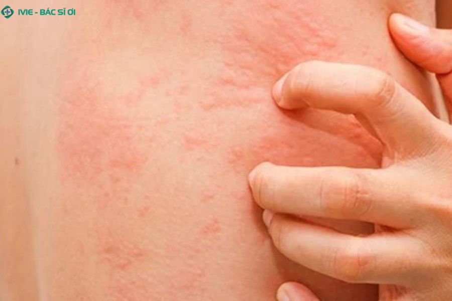 Vùng da xuất hiện nhiều nốt đỏ li ti gây ngứa ngáy, khó chịu
