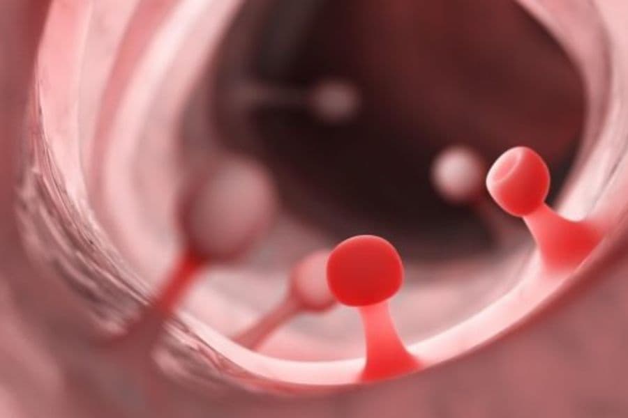 Polyp dạ dày có phải là ung thư không?