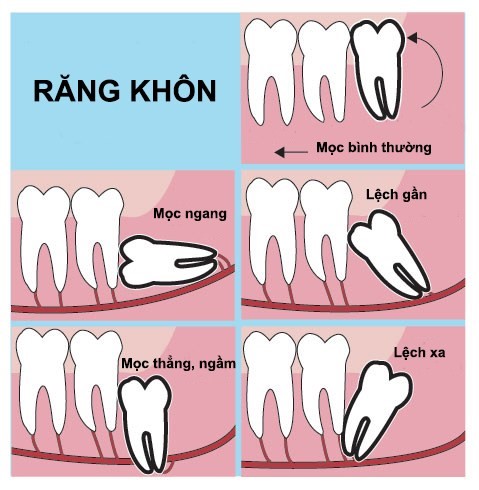 Mot-vai-loai-moc-rang-khon