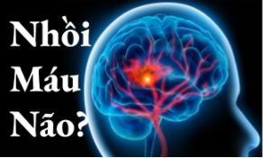 Đột quỵ não và những điều bạn cần biết!