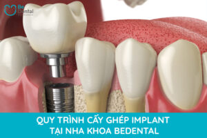 Cấy Trồng implant - Osstem