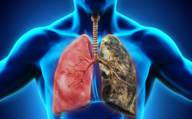 28. Tầm soát lao phổi nâng cao