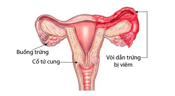 Những nguyên nhân gây viêm ống dẫn trứng và cách điều trị...