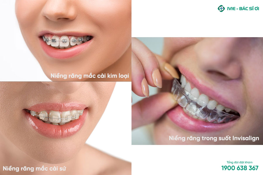 3 loại niềng răng phổ biến hiện nay