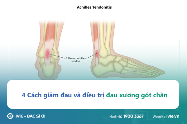 4 Cách giảm đau và điều trị đau xương gót chân