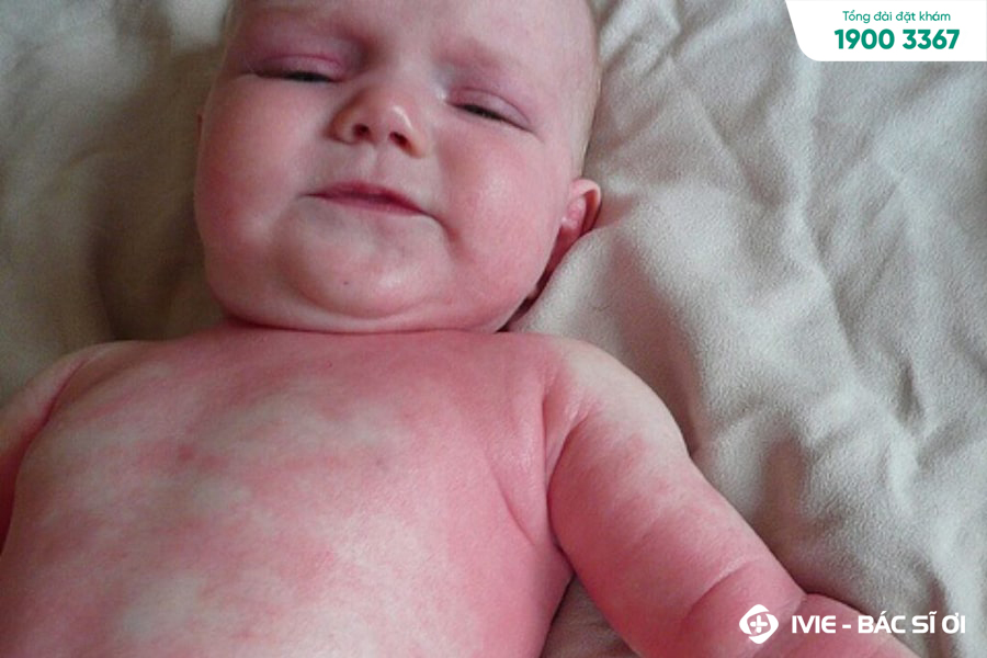 Trẻ bị nổi mẩn đỏ có gây ra nguy hiểm không?