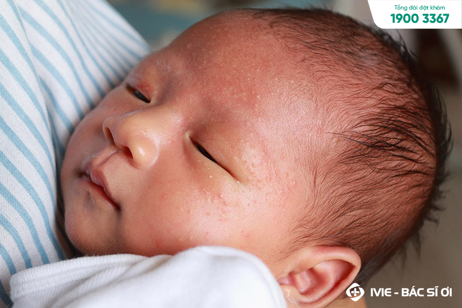 Biểu hiện trẻ bị nổi mụn sữa