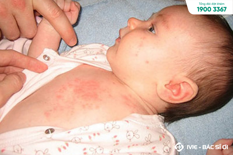 Nếu nổi mẩn đỏ kèm sốt thì nên đưa trẻ đi khám