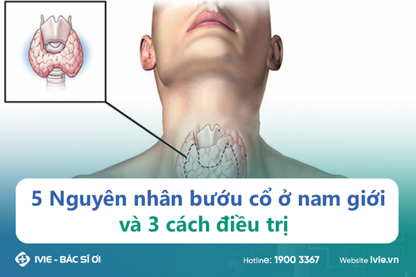 5 Nguyên nhân bướu cổ ở nam giới và 3 cách điều trị