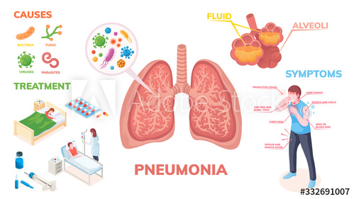 Bệnh viêm phổi: Biến chứng, phòng ngừa và cách điều trị