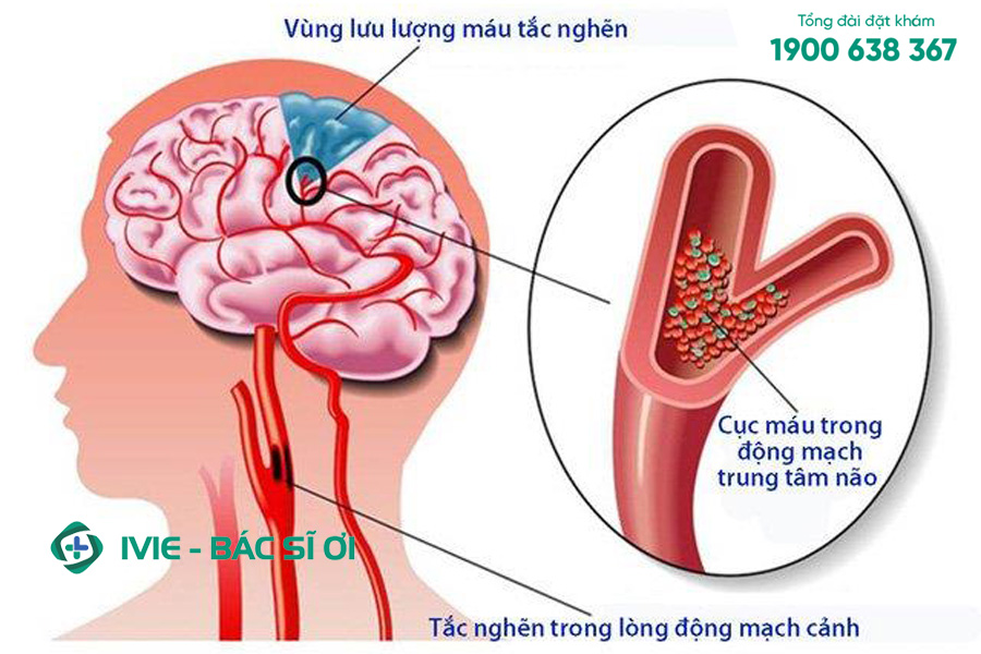 Dấu hiệu tai biến mạch máu não cần đi khám sớm