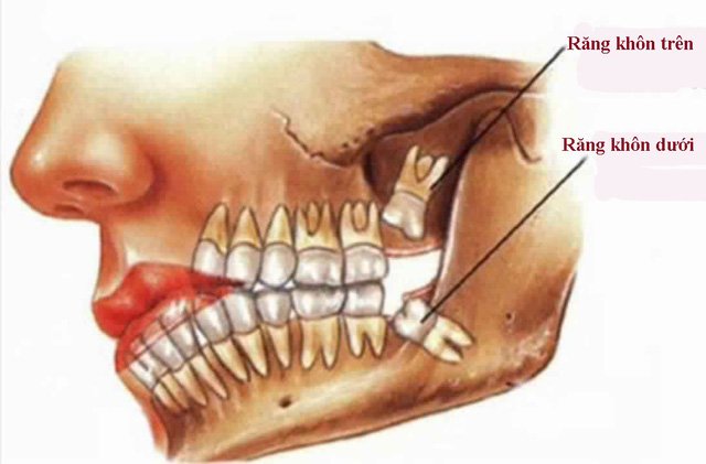 Nhổ Răng khôn hàm dưới mọc lệch