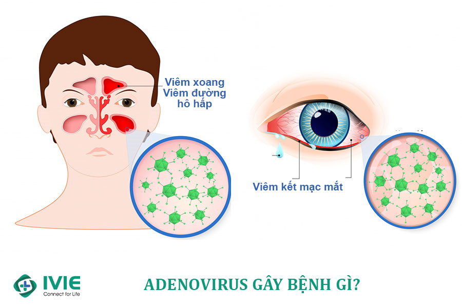 Adenovirus gây bệnh gì?