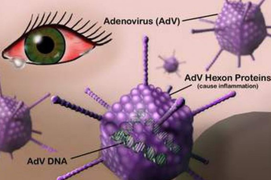 Viêm kết mạc do Adenovirus gây ra