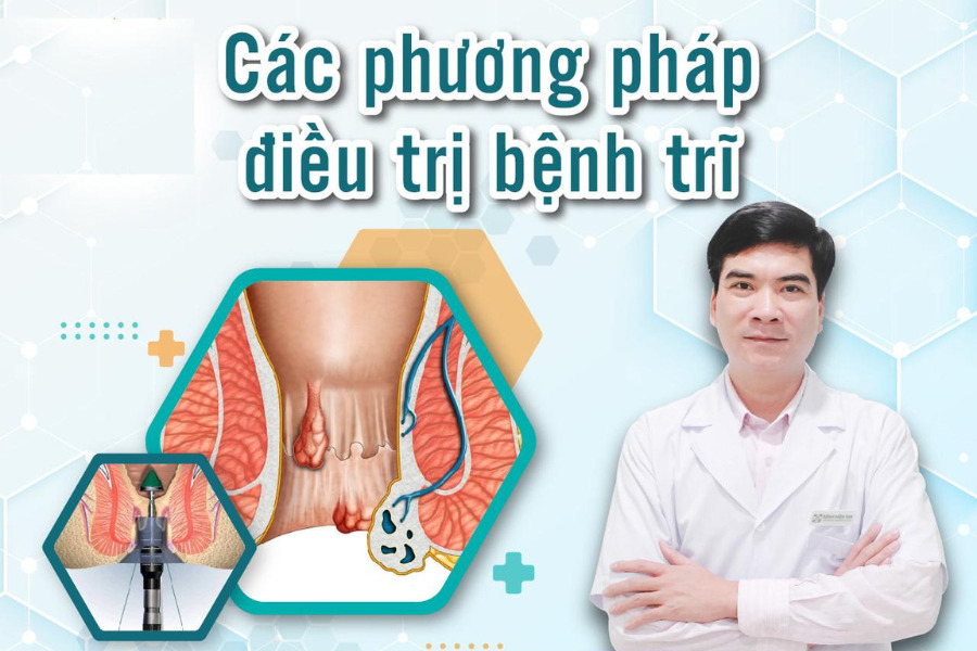 Bác sĩ Trần Nguyên Phú điều trị trĩ bằng phương pháp Longo