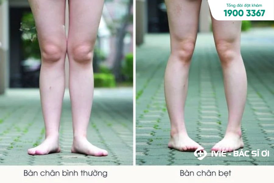 Hình ảnh minh họa bàn chân bẹt