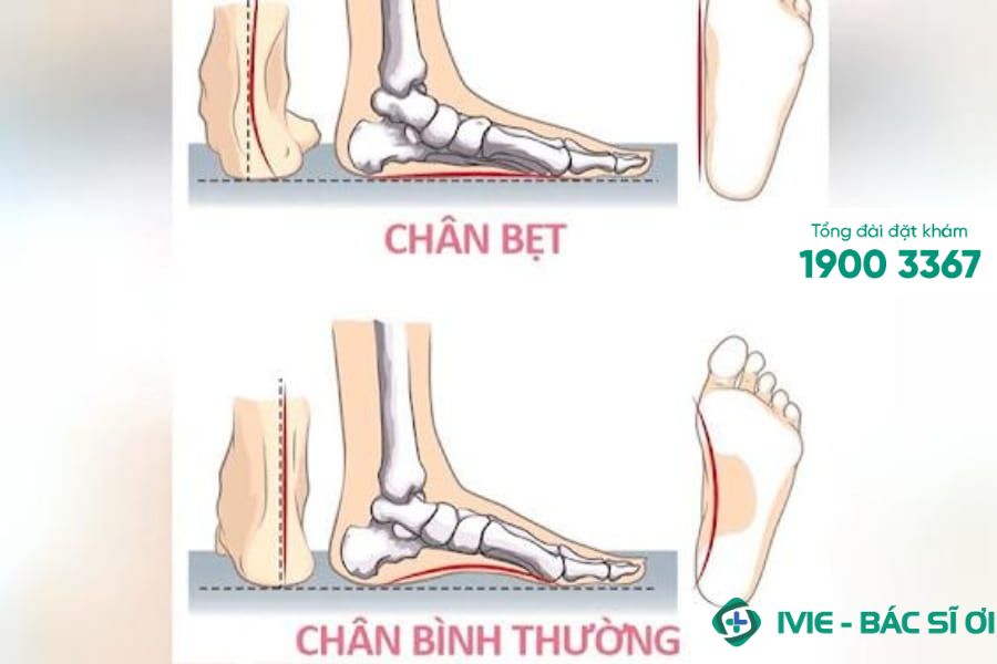 Tìm hiểu về bệnh bàn chân bẹt ở trẻ nhỏ