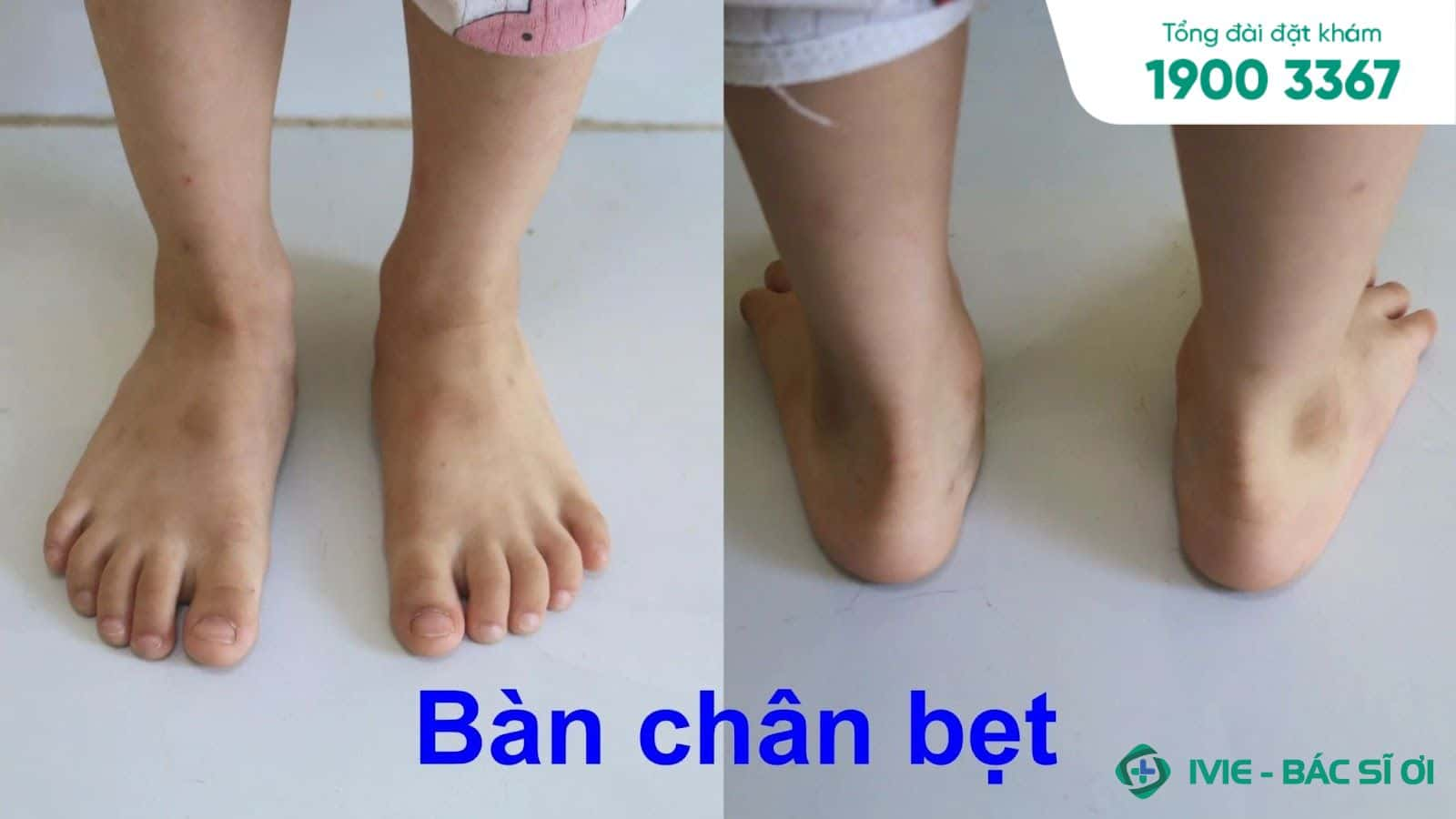 Hình ảnh minh họa bàn chân bẹt ở trẻ