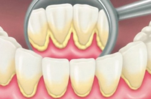 Thời điểm nào nên lấy cao răng định kỳ? Cách phòng ngừa cao ...