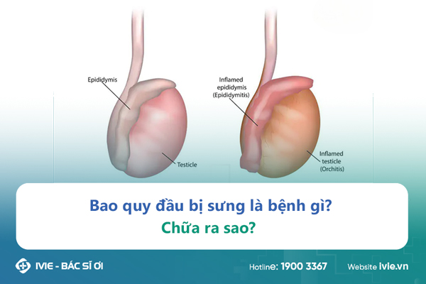 Bao quy đầu bị sưng là bệnh gì? Chữa ra sao?