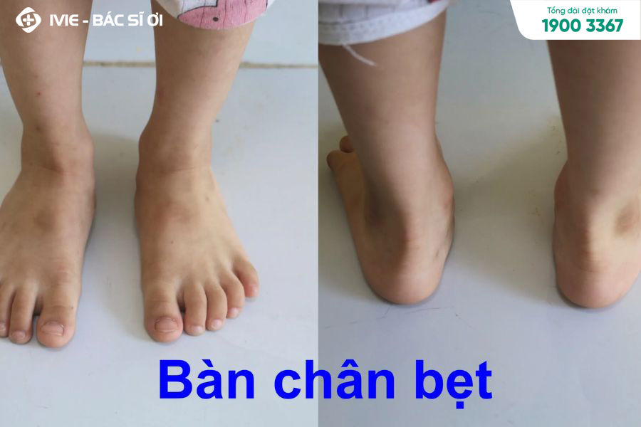 Bàn chân bẹt là tình trạng nguy hiểm, có ảnh hưởng đến cơ xương chân của trẻ