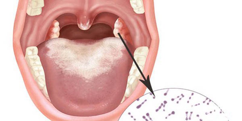Vi khuẩn thường khu trú và làm thương tổn đường hô hấp trên (mũi, họng, thanh quản)