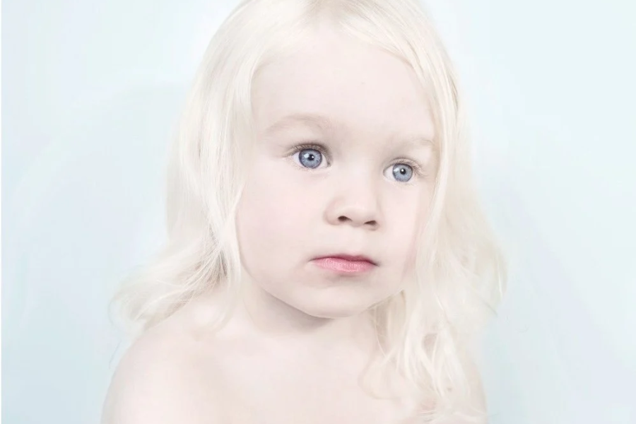 Bệnh bạch tạng (Albinism) là một bệnh lý di truyền hiếm gặp.